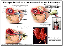 Aborto